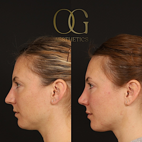 Rhinoplasty Before & After Gallery - Patient 316259 - Image 4