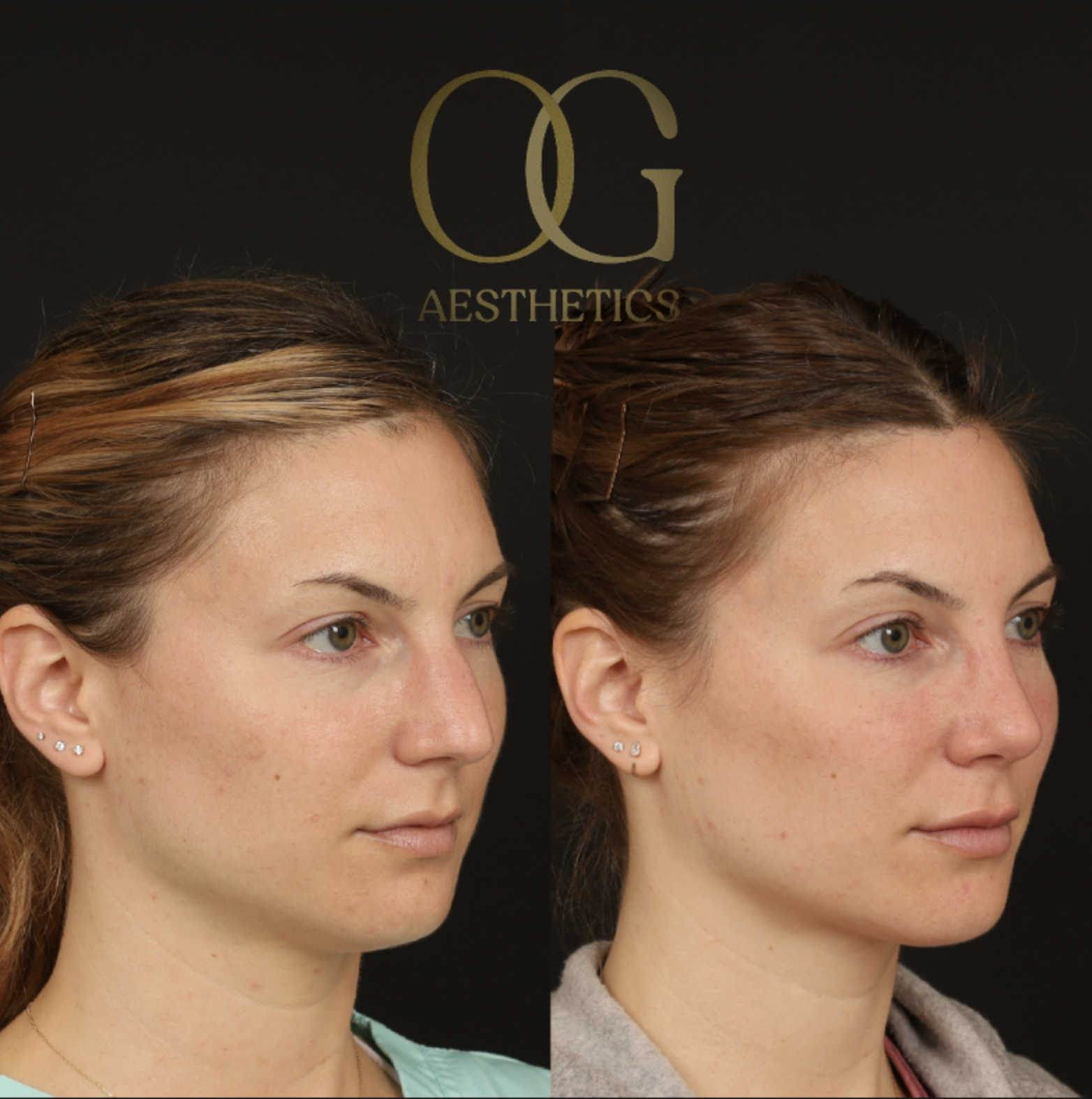 Rhinoplasty Before & After Gallery - Patient 316259 - Image 5