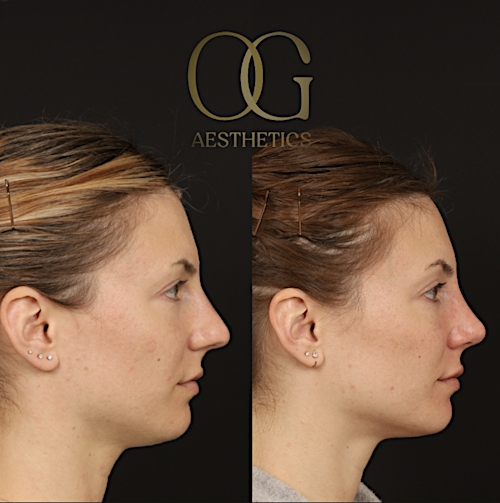 Rhinoplasty Before & After Gallery - Patient 316259 - Image 1