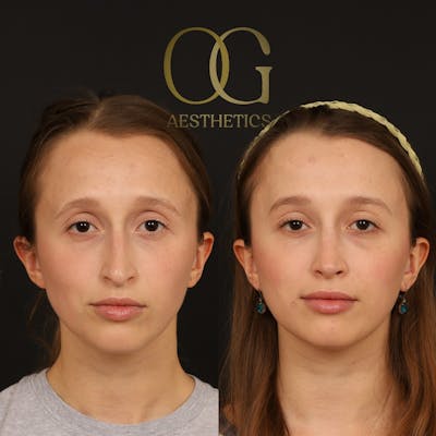Brow Lift Before & After Gallery - Patient 709988 - Image 1