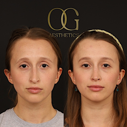 Rhinoplasty Before & After Gallery - Patient 357902 - Image 2