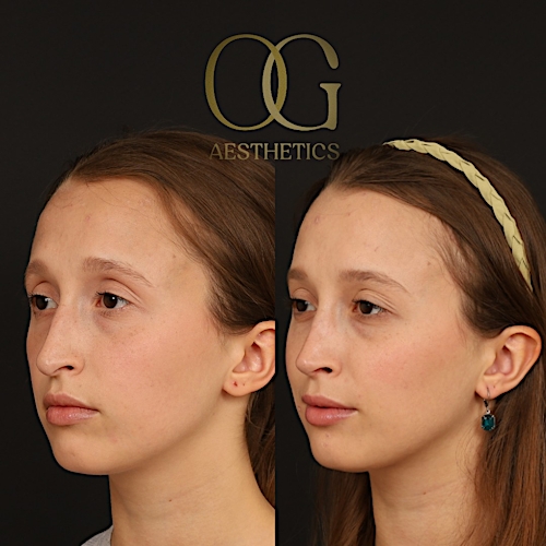 Rhinoplasty Before & After Gallery - Patient 357902 - Image 3