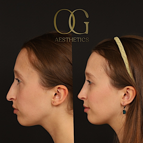 Rhinoplasty Before & After Gallery - Patient 357902 - Image 4