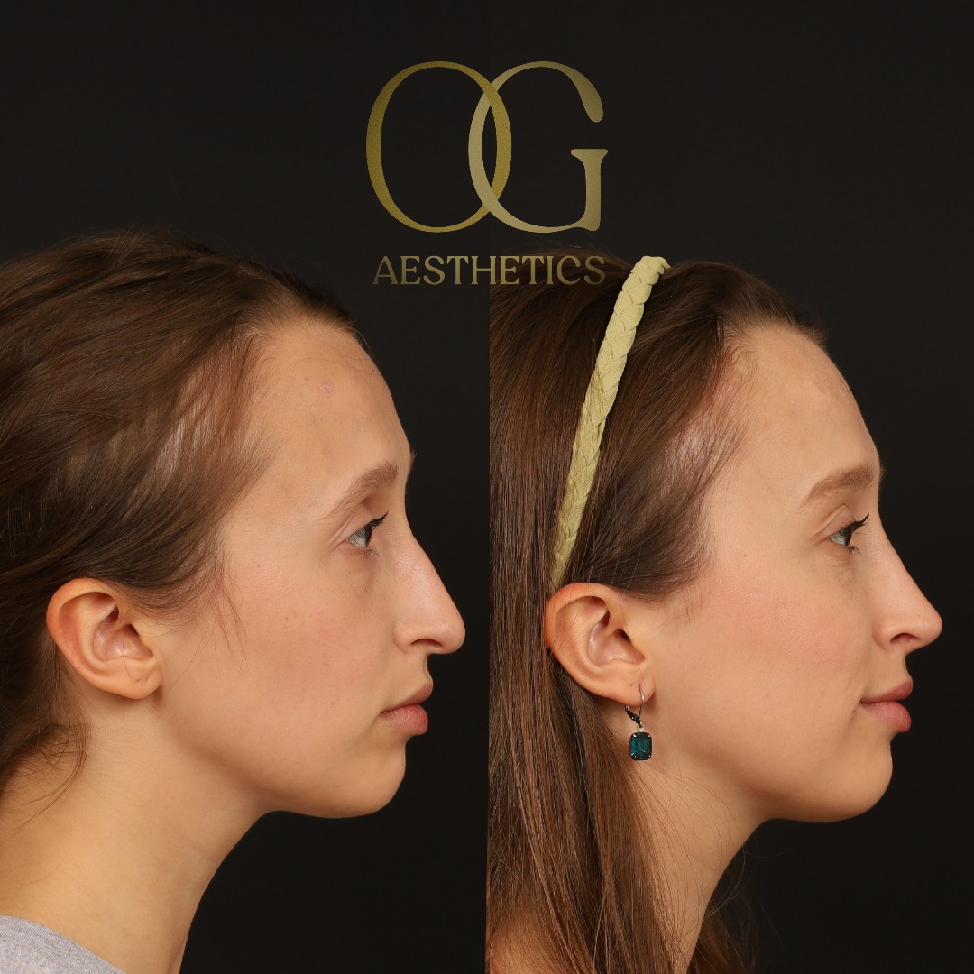 Brow Lift Before & After Gallery - Patient 709988 - Image 5