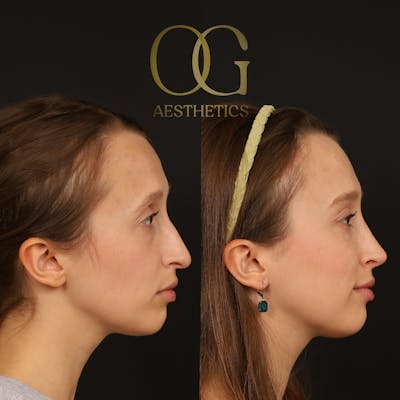 Rhinoplasty Before & After Gallery - Patient 357902 - Image 1