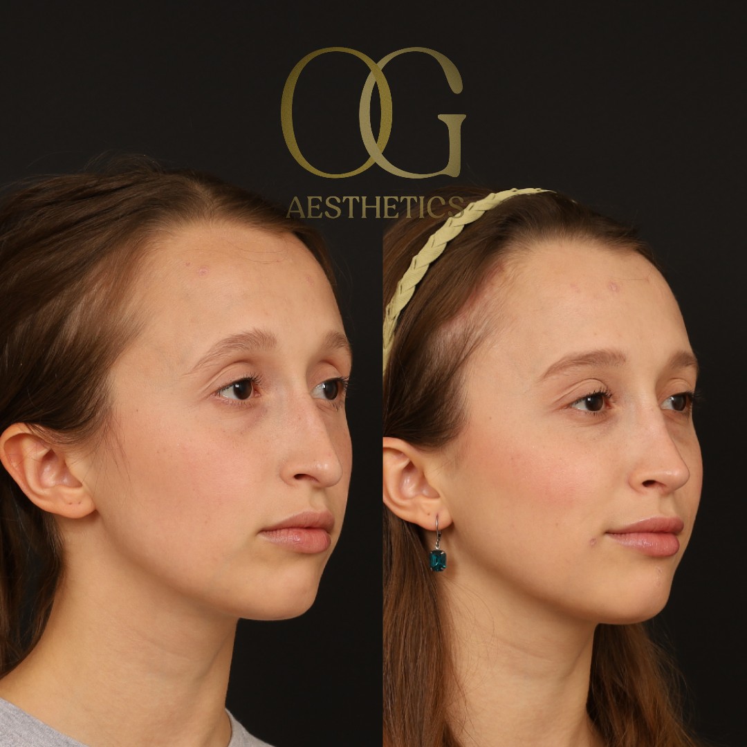 Brow Lift Before & After Gallery - Patient 709988 - Image 4