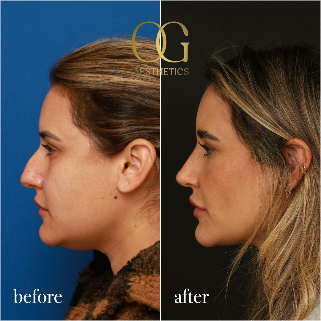 Rhinoplasty Before & After Gallery - Patient 310984 - Image 4