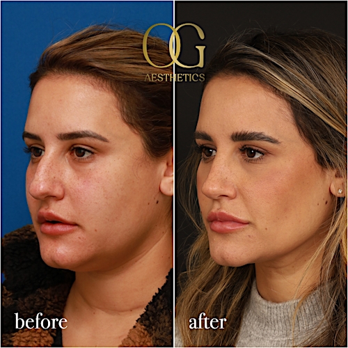 Rhinoplasty Before & After Gallery - Patient 310984 - Image 5