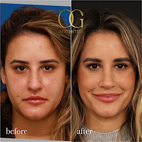 Rhinoplasty Before & After Gallery - Patient 310984 - Image 3