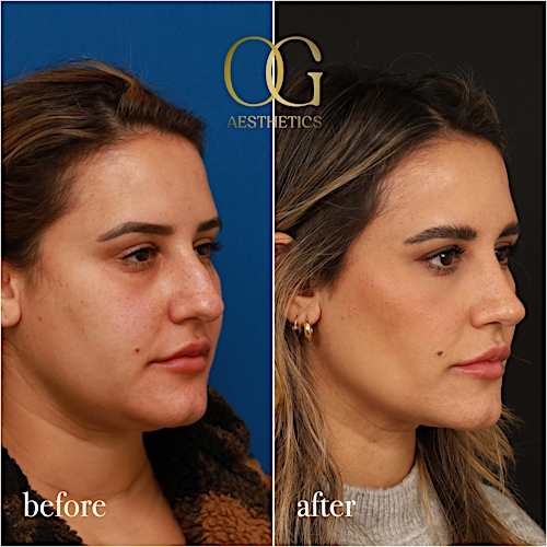 Rhinoplasty Before & After Gallery - Patient 310984 - Image 2