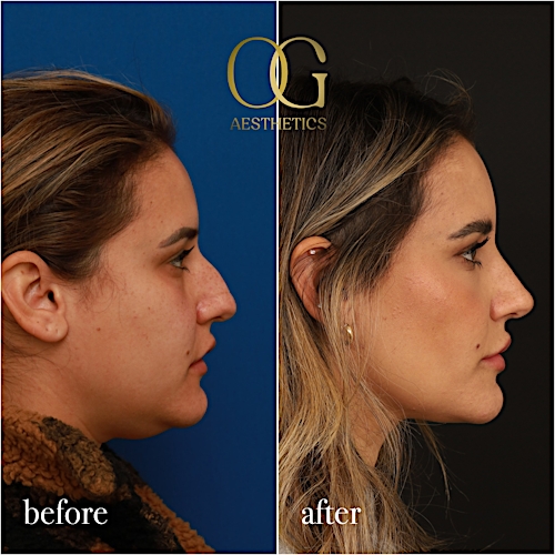 Rhinoplasty Before & After Gallery - Patient 310984 - Image 1