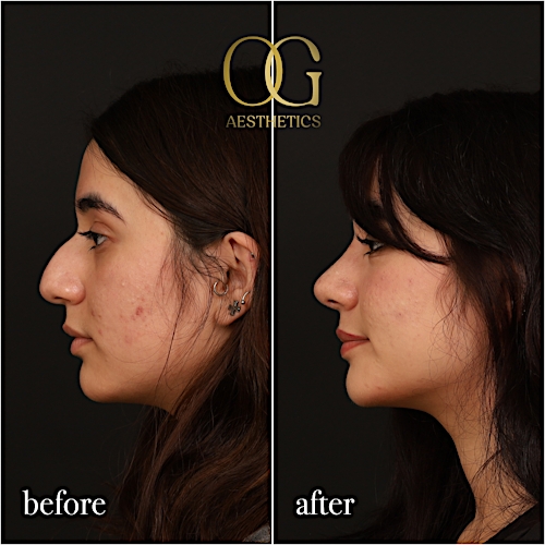 Rhinoplasty Before & After Gallery - Patient 235381 - Image 6