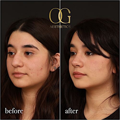 Rhinoplasty Before & After Gallery - Patient 235381 - Image 5