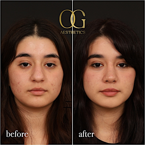 Rhinoplasty Before & After Gallery - Patient 235381 - Image 3