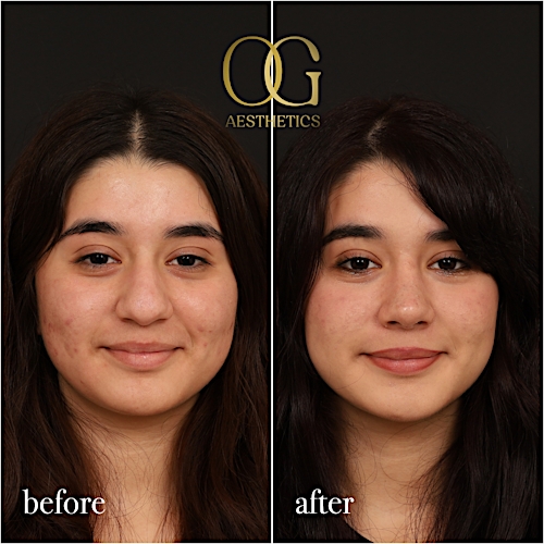 Rhinoplasty Before & After Gallery - Patient 235381 - Image 4