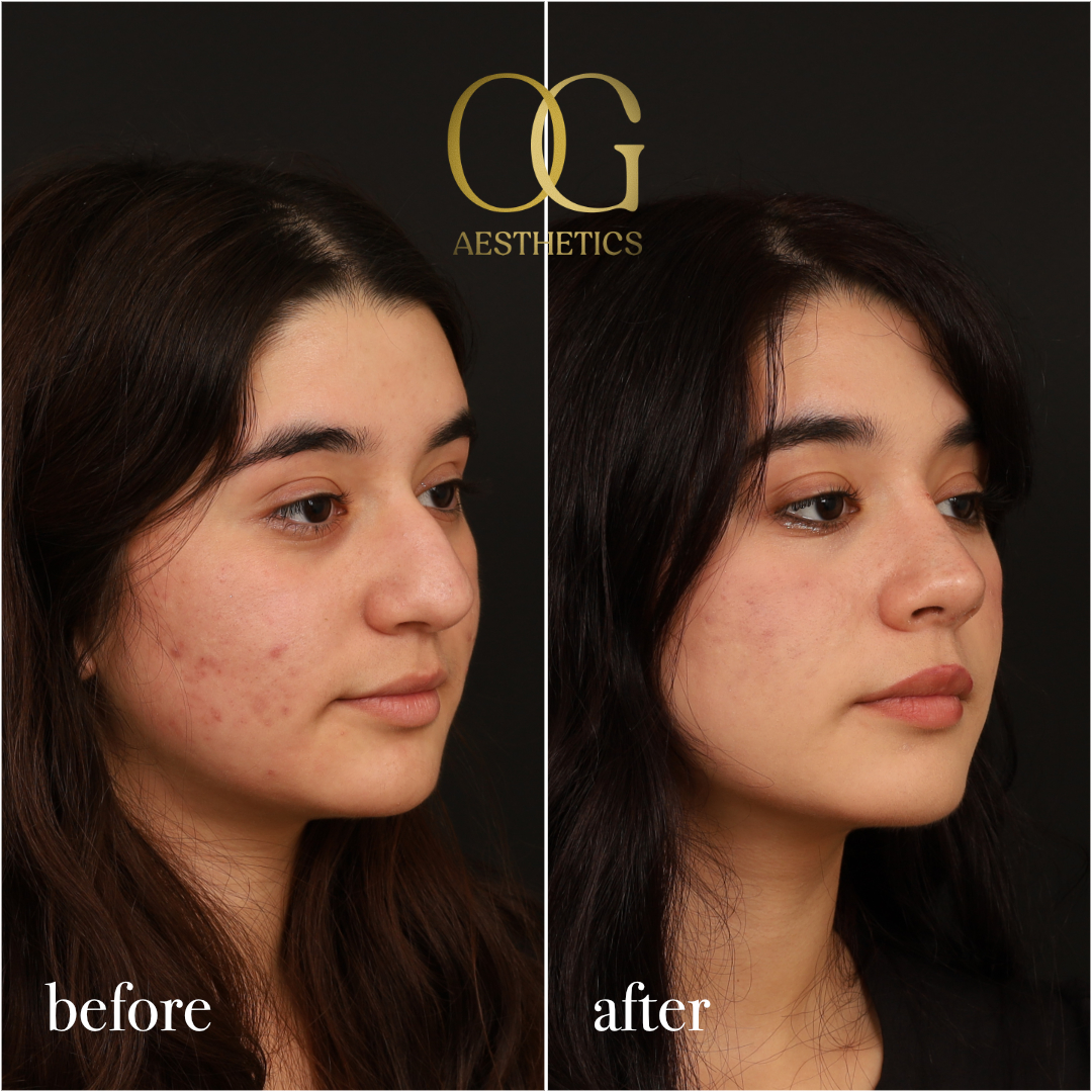 Rhinoplasty Before & After Gallery - Patient 235381 - Image 2