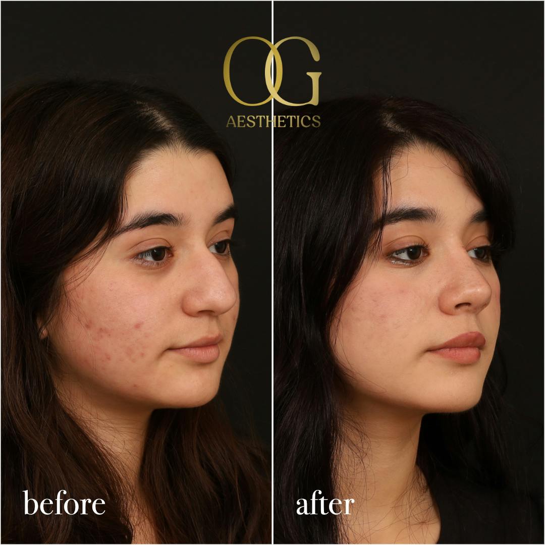 Rhinoplasty Before & After Gallery - Patient 235381 - Image 2