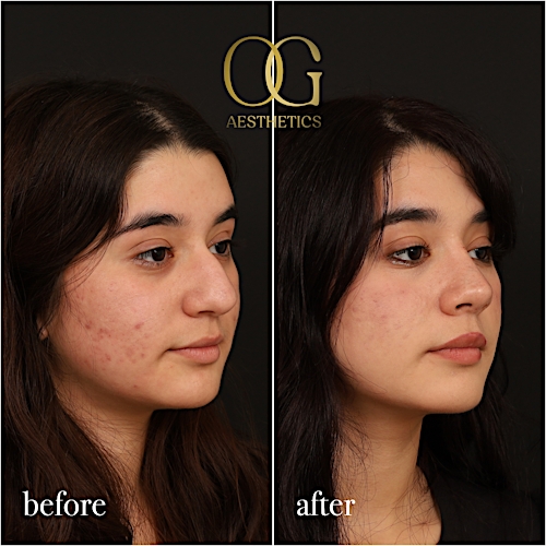 Rhinoplasty Before & After Gallery - Patient 235381 - Image 2