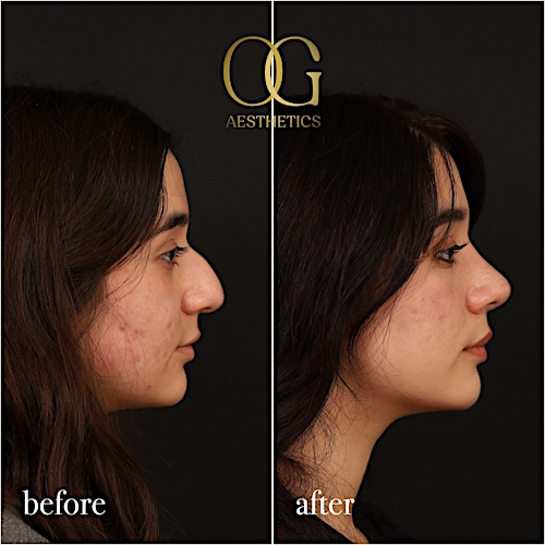 Rhinoplasty Before & After Gallery - Patient 235381 - Image 1