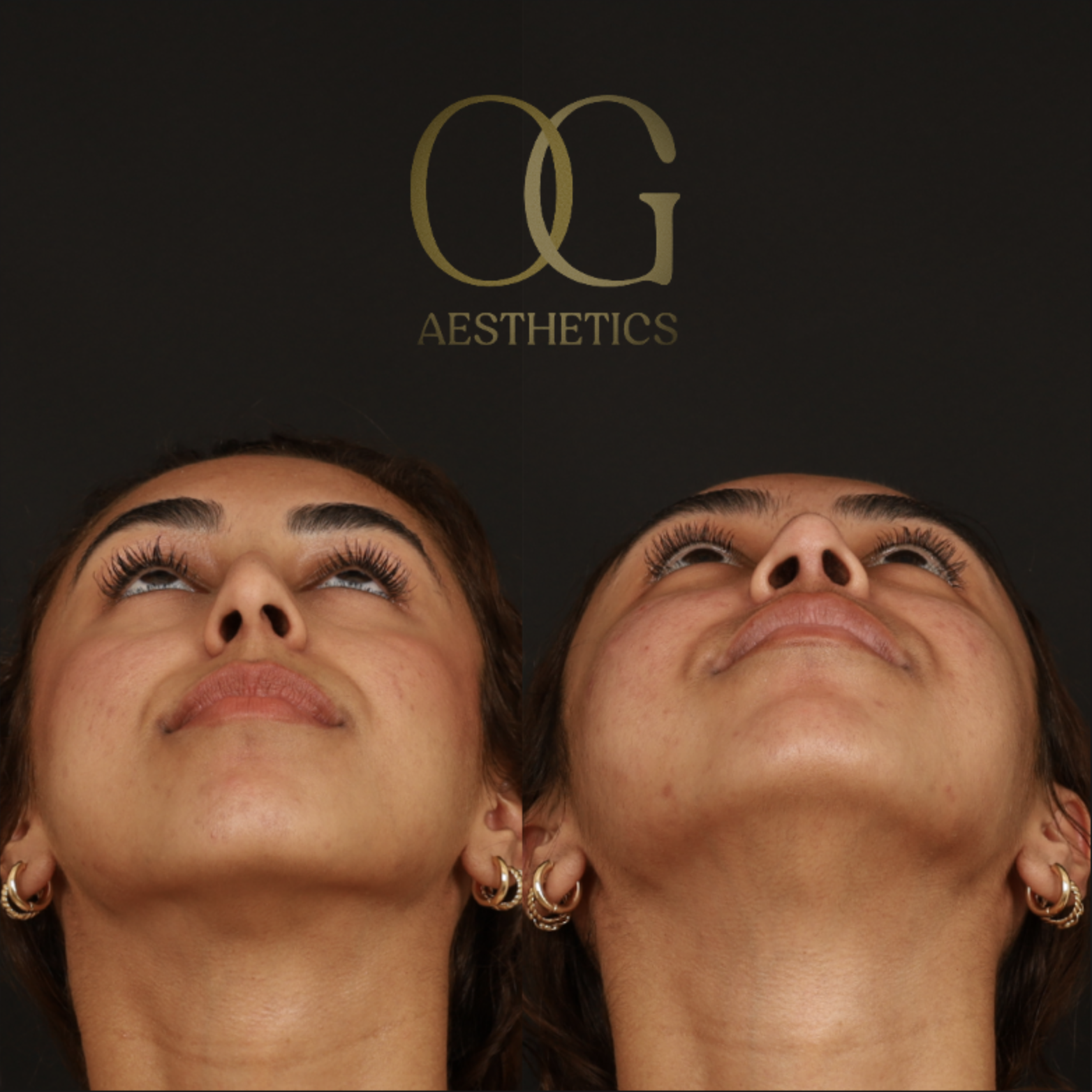 Rhinoplasty Before & After Gallery - Patient 225665 - Image 4