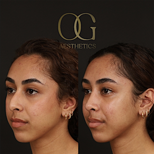 Rhinoplasty Before & After Gallery - Patient 225665 - Image 5