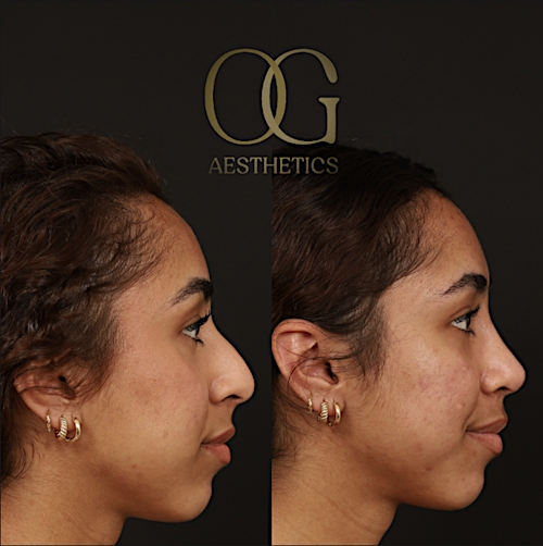 Rhinoplasty Before & After Gallery - Patient 225665 - Image 1