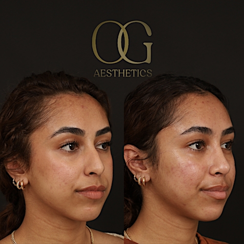 Rhinoplasty Before & After Gallery - Patient 225665 - Image 2