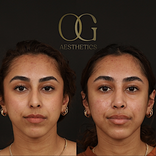 Rhinoplasty Before & After Gallery - Patient 225665 - Image 3
