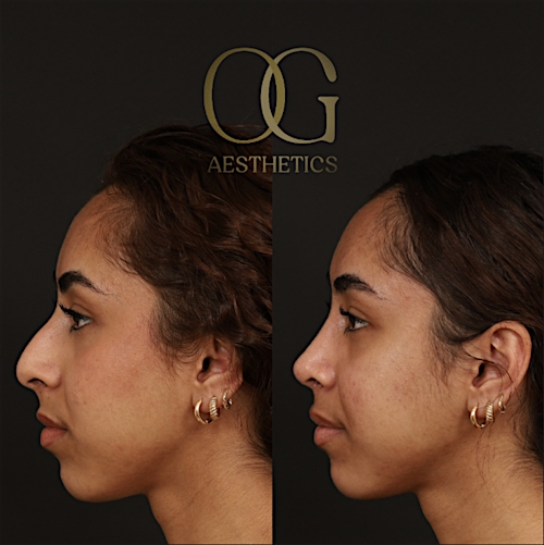 Rhinoplasty Before & After Gallery - Patient 225665 - Image 6
