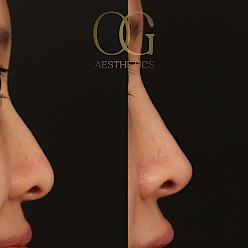 Non-Surgical Rhinoplasty Before & After Gallery - Patient 411061 - Image 2