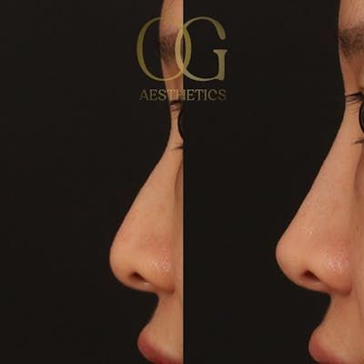 Non-Surgical Rhinoplasty Before & After Gallery - Patient 411061 - Image 1