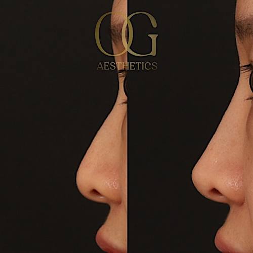 Non-Surgical Rhinoplasty Before & After Gallery - Patient 411061 - Image 1
