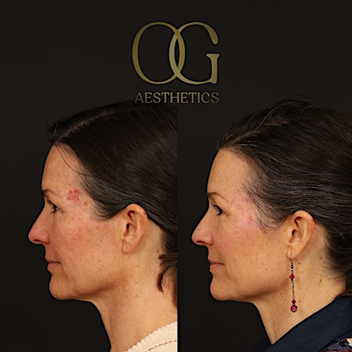 Facial Reconstruction Before & After Gallery - Patient 199477 - Image 3