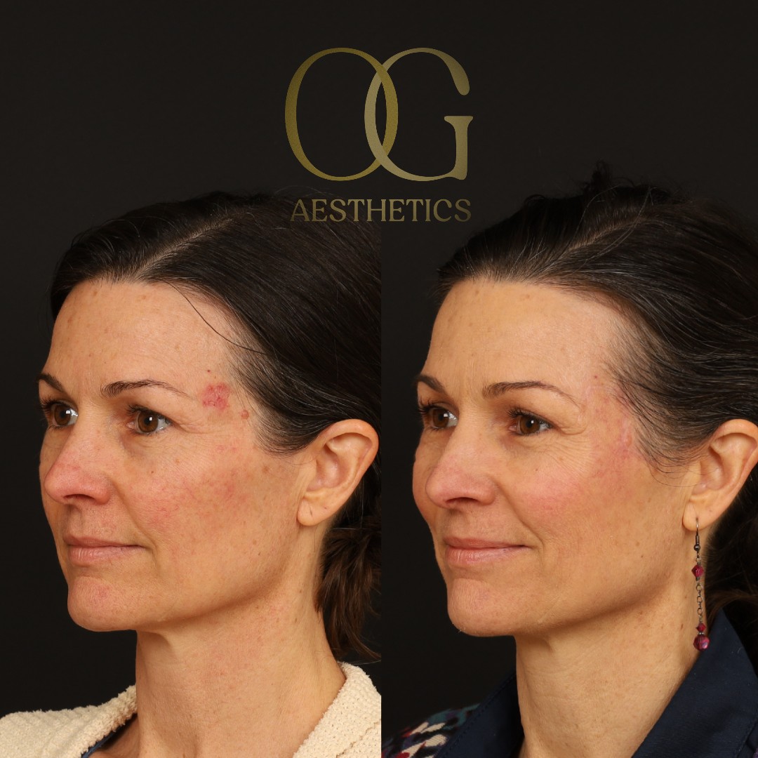 Facial Reconstruction Before & After Gallery - Patient 199477 - Image 2