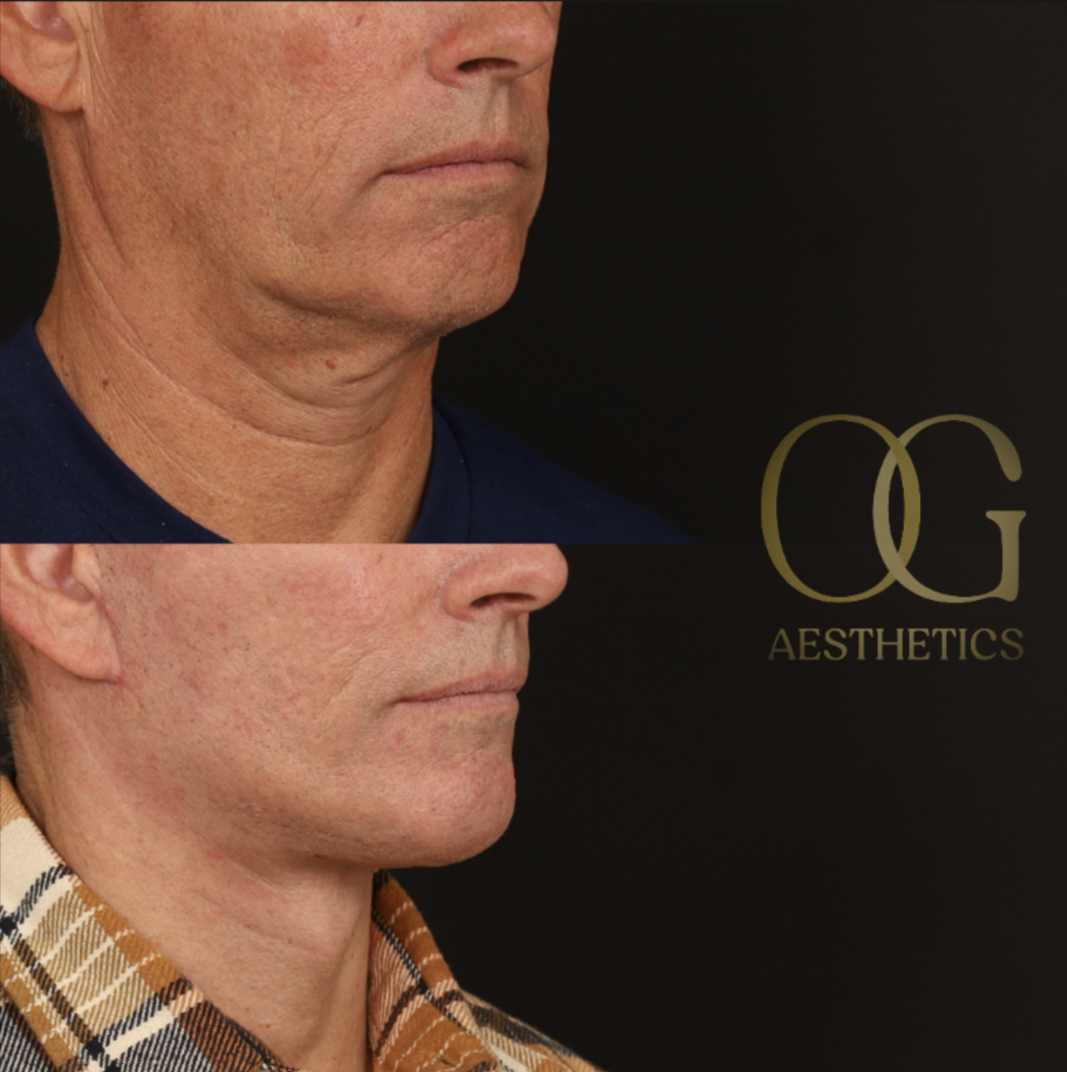 Neck Lift Before & After Gallery - Patient 349751 - Image 2