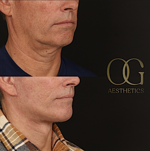 Facelift Before & After Gallery - Patient 189105 - Image 2