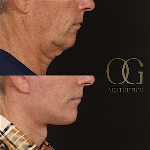 Facelift Before & After Gallery - Patient 189105 - Image 3