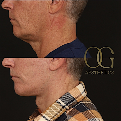 Facelift Before & After Gallery - Patient 189105 - Image 5
