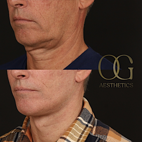 Neck Lift Before & After Gallery - Patient 349751 - Image 4