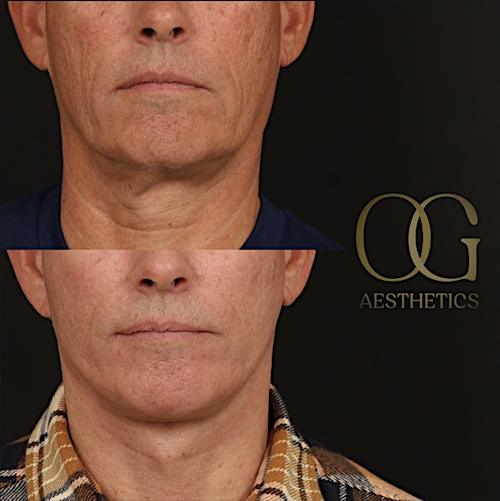 Facelift Before & After Gallery - Patient 189105 - Image 1