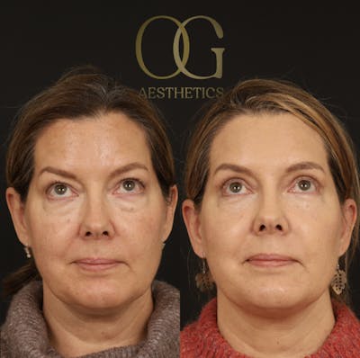 Blepharoplasty Before & After Gallery - Patient 592690 - Image 1