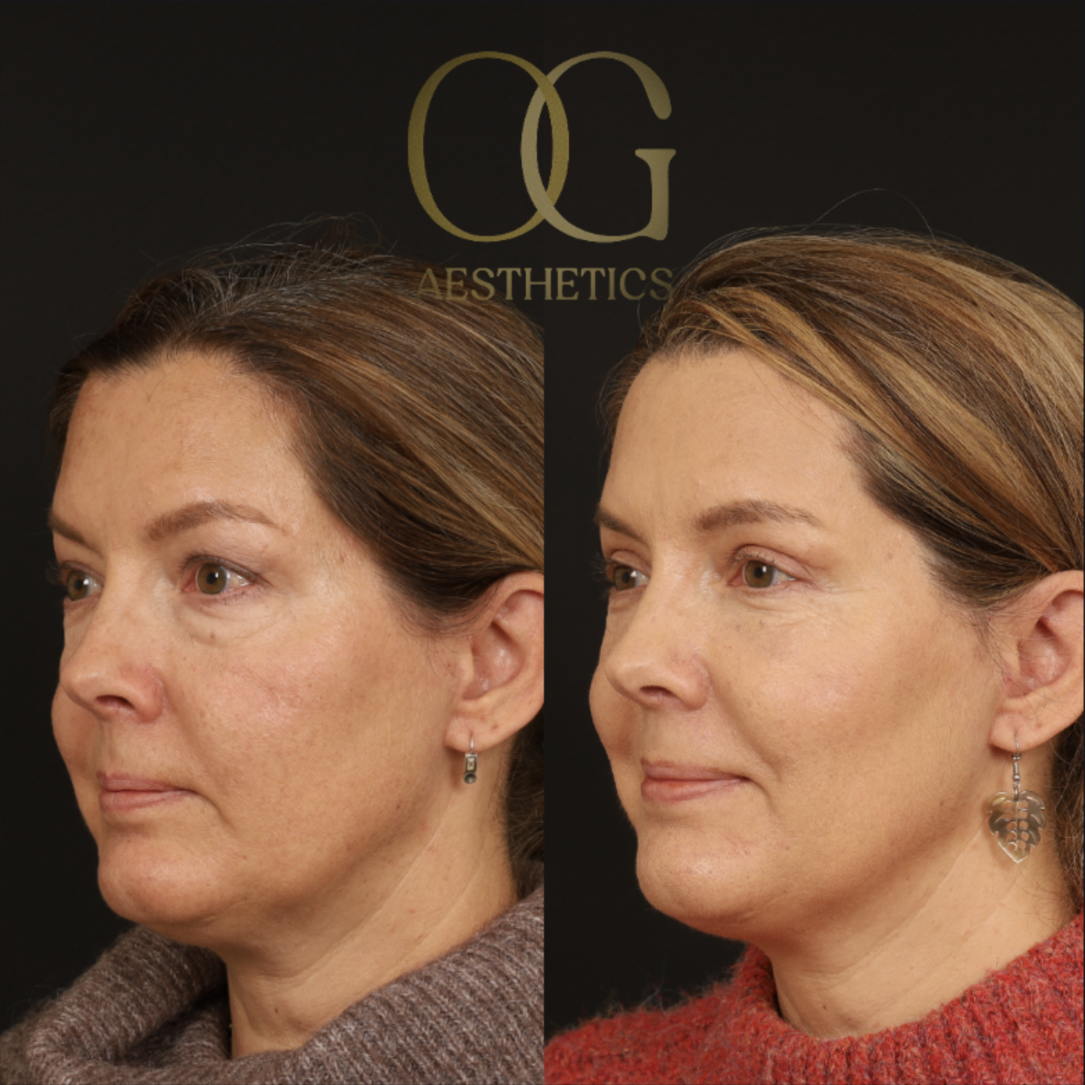 Blepharoplasty Before & After Gallery - Patient 592690 - Image 5