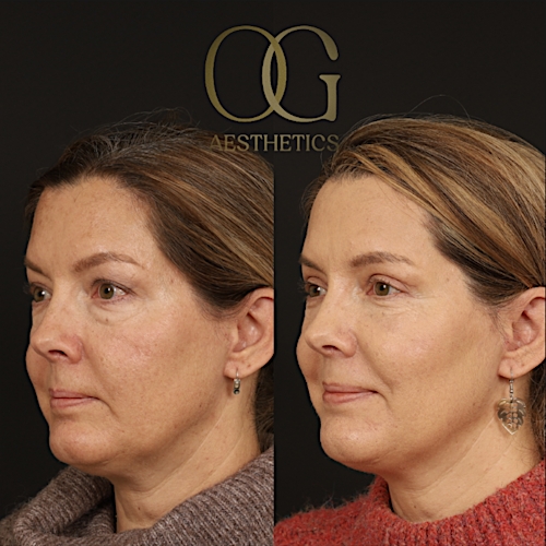 Blepharoplasty Before & After Gallery - Patient 592690 - Image 5