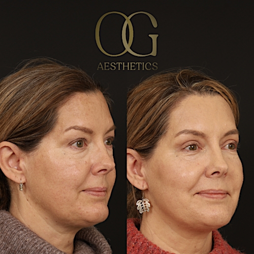 Blepharoplasty Before & After Gallery - Patient 592690 - Image 3