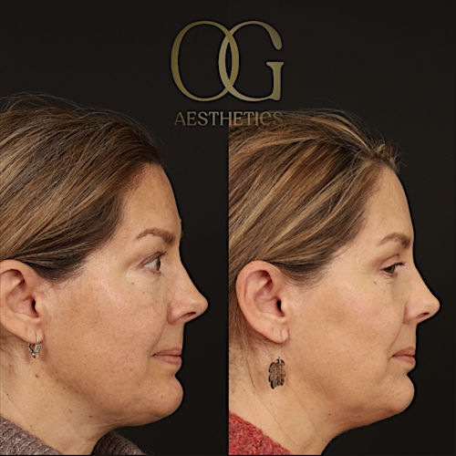 Blepharoplasty Before & After Gallery - Patient 592690 - Image 4