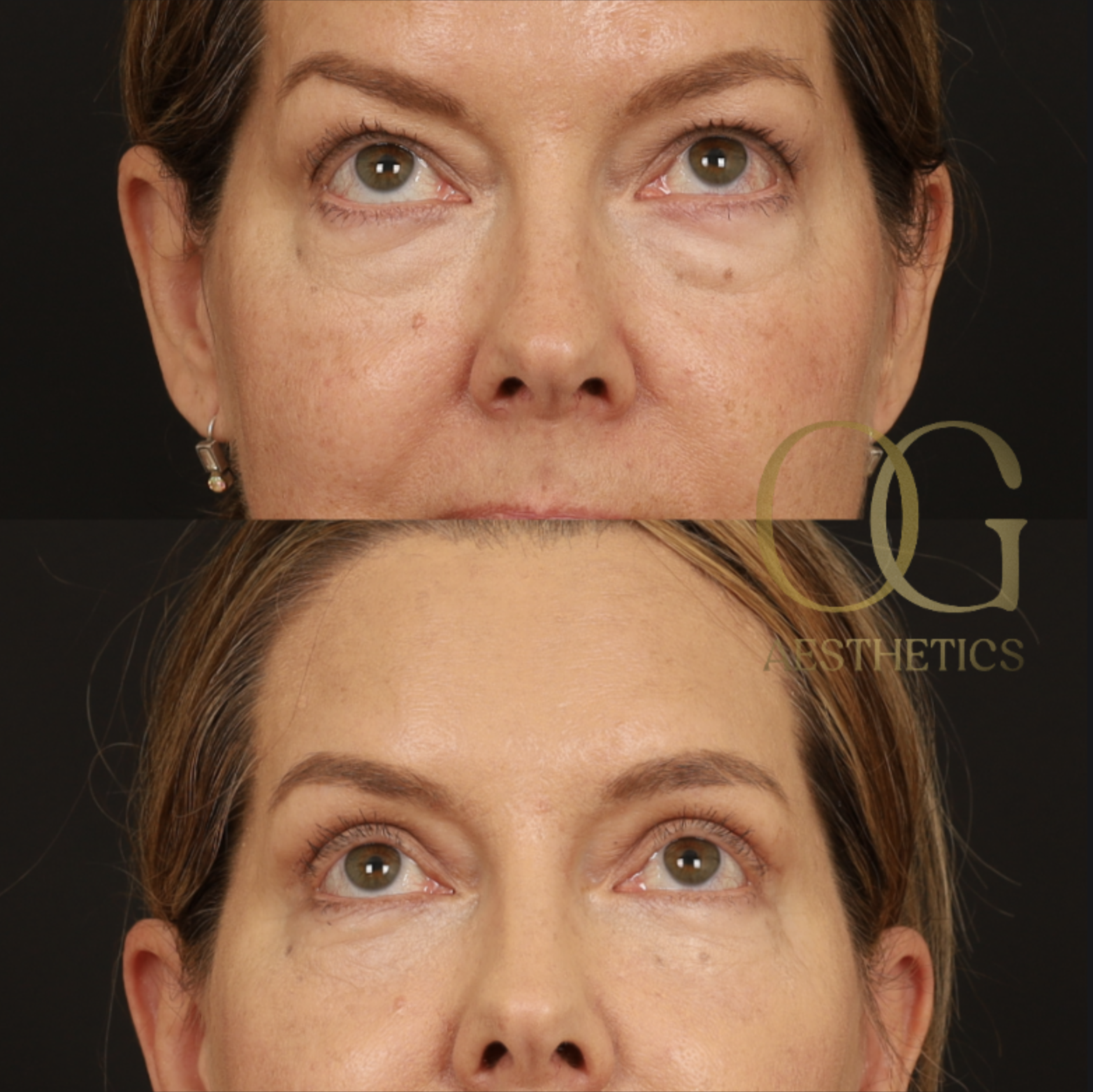 Blepharoplasty Before & After Gallery - Patient 592690 - Image 7