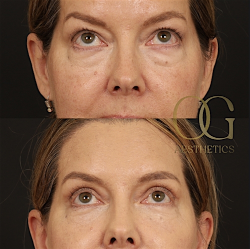 Blepharoplasty Before & After Gallery - Patient 592690 - Image 7