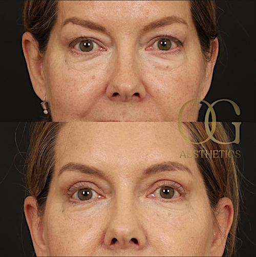 Blepharoplasty Before & After Gallery - Patient 592690 - Image 8