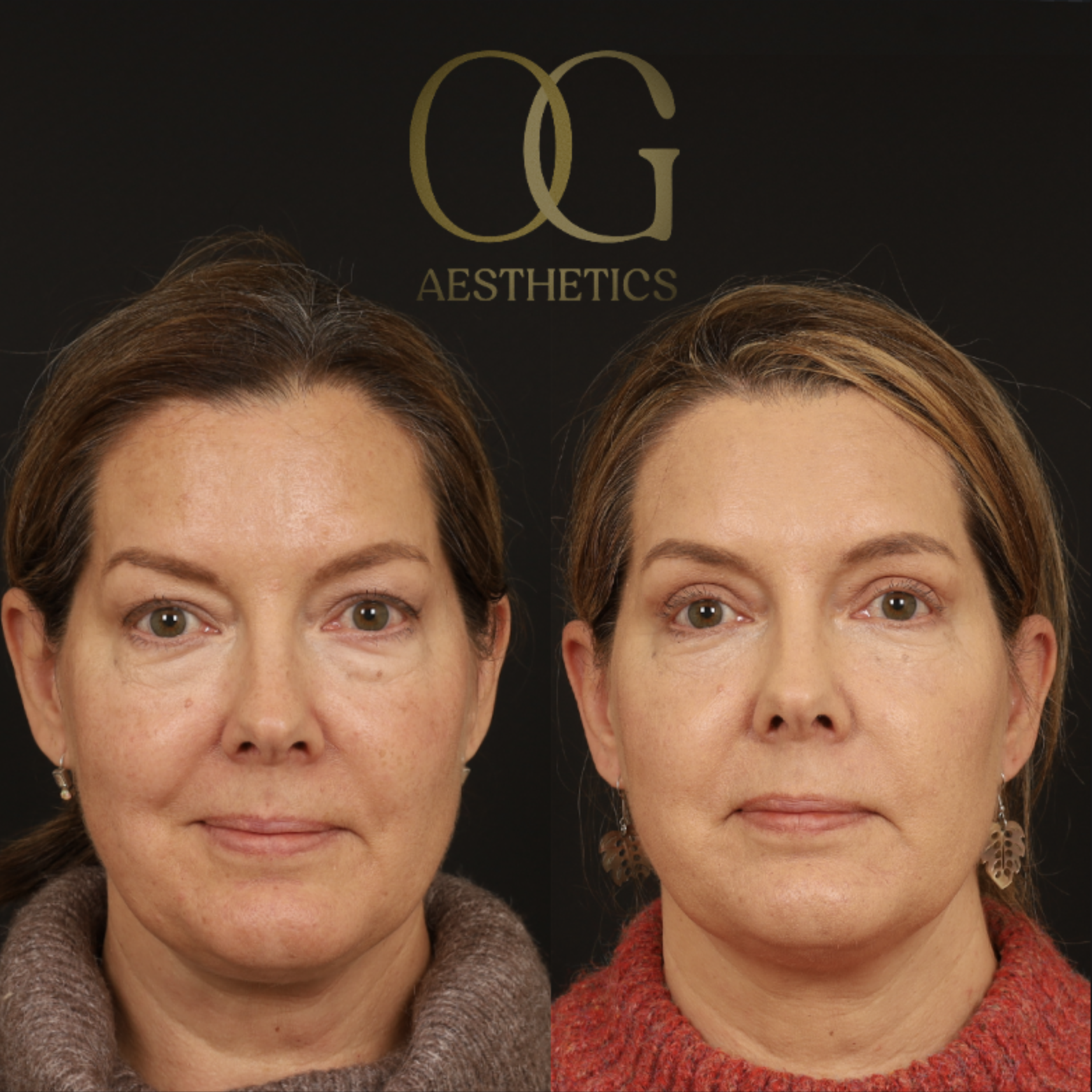 Blepharoplasty Before & After Gallery - Patient 592690 - Image 2