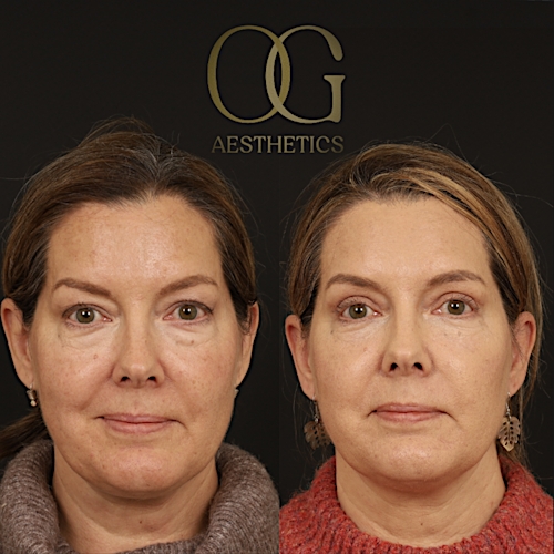 Blepharoplasty Before & After Gallery - Patient 592690 - Image 2